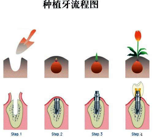 北京做种植牙大概需要多长时间