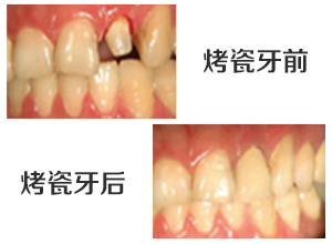 造成牙齿缺失的原因是什么